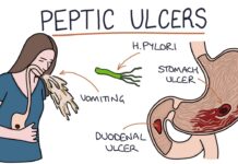 How to treat ulcers?