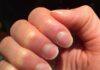 Nails reveal your health status