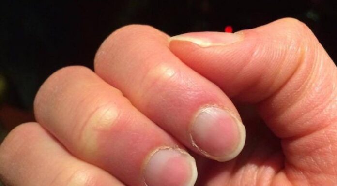 Nails reveal your health status