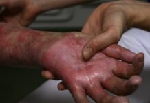 Understanding Burns: Risk, Prevention and First Aid